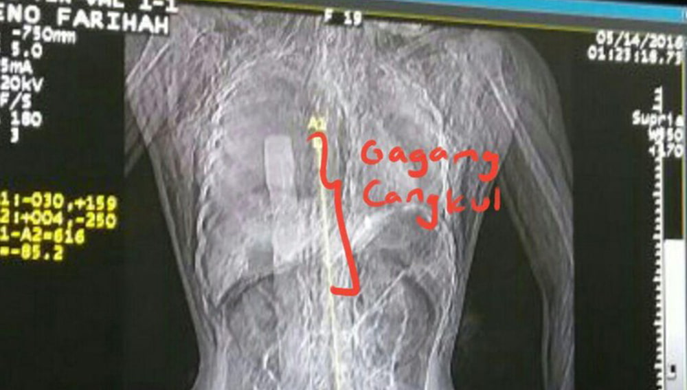 A photo of the X-ray image of Eno Farihah's torso, showing how far up the hoe went.