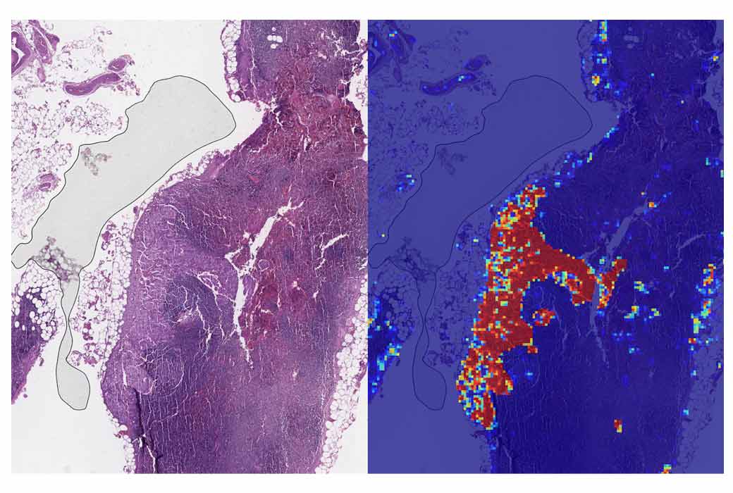 Google AI detecting cancer